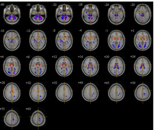 Fig. 4 White matter volume in 22q11DS subjects vs. controls (not controlled for IQ). Volumetric excesses in 22q11DS (red/yellow)