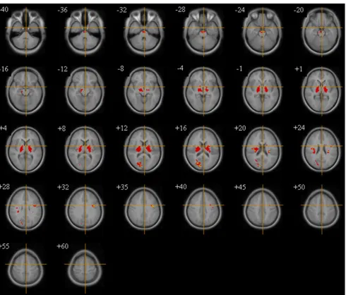 Fig. 5 White Matter volume in 22q11DS subjects vs. controls (controlled for IQ). Significant volumetric excesses in 22q11DS (red/yellow).Ascending transverse sections; (reversed where L = R, R = L)