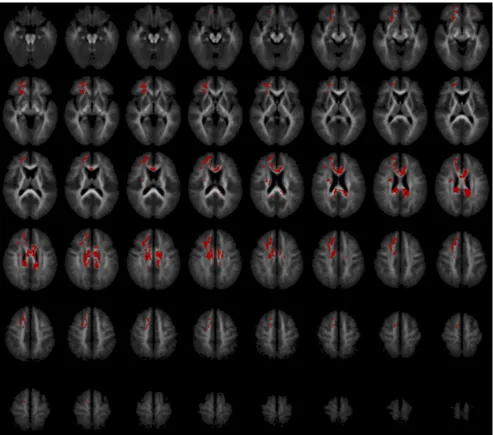 Fig. 3 Fractional anisotropy deficits within 22q11DS group in subjects with VCOMT relative to MCOMT