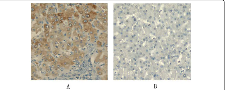 Figure 1 CXCR7 expression in human hepatocellular carcinoma tissues and normal liver tissues