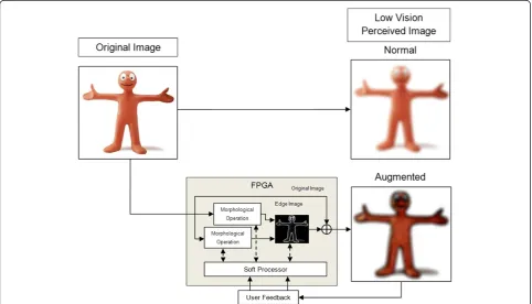 Figure 1 Conceptual overview of a morphological high spatial frequency augmented vision system on FPGA for low-vision aid.