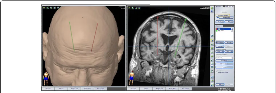 Figure 1 Transfrontal trajectory for deep brain stimulation of the basolateral amygdala.