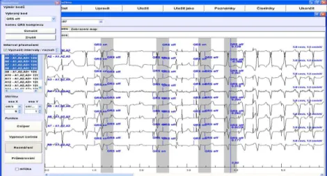 Fig 5. Example of ECG characteristic points marking 