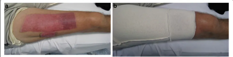 Fig. 1 a. shows a healed donor scar located on the anterior thigh, that had application of IPG and the hypervascular distal donor that did not.b