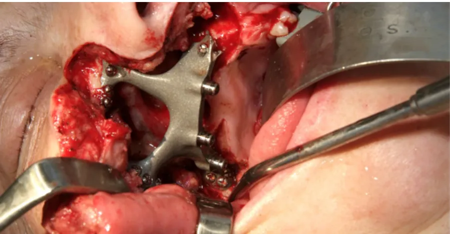 Figure 3: The definitive maxillofacial implant in situ during reconstructive surgery. The 