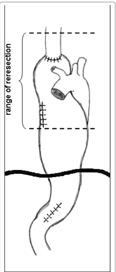Figure 2 The range of gastric tube and esophageal stumpresection.