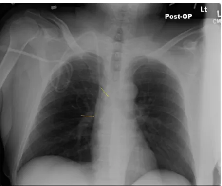 Figure 1 Long-term right internal jugular venous catheter (tip at orange arrow) appropriately positioned relative to right tracheobronchial angle (at yellow arrow).