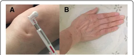 Figure 3 The main procedure for the measurement of diffusethe contralateral hand, including the wrist, into nociceptive coldwater (10 to 12°C) for 1 minute, and the doctors will rate the intensityof the 180-g von Frey filament-induced pain at the Ashi-poin