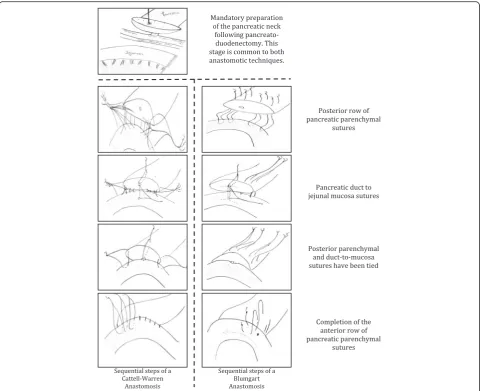 Fig. 1 Schematic of the stages of pancreatic anastomosis construction