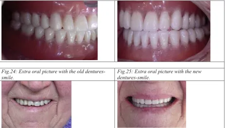 Fig.24: Extra oral picture with the old dentures-