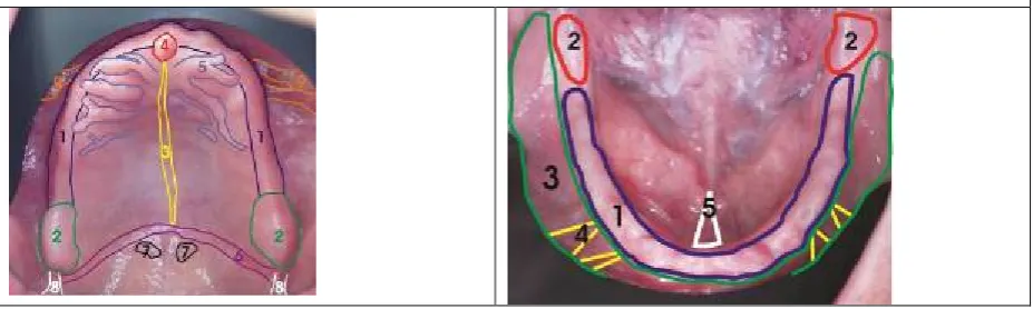 Fig. 27: Schematic example of the elements of the prosthetic area of lower jaw: 1. crista alveolaris mandibulae; 2
