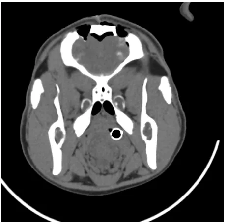 Figure 8 Postoperative computed tomogram.Notes: Two burr holes can be seen on the top of the skull