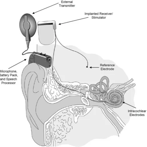 Figure 1.1: The multiple parts of a cochlear implant. External components pick up sound 