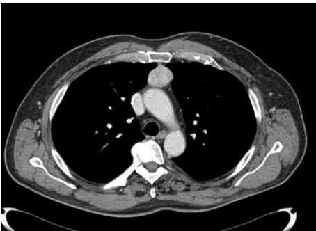 Figure 5 Chest CT scan (mediastinal window) showing small middle-mediastinal thymoma.Abbreviation: CT, computed tomography.