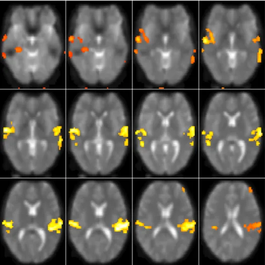 Figure 2: PPMs representing areas of auditory activation, estimated by the multilevel method for axial slices 13–24 of the swrfM data set.