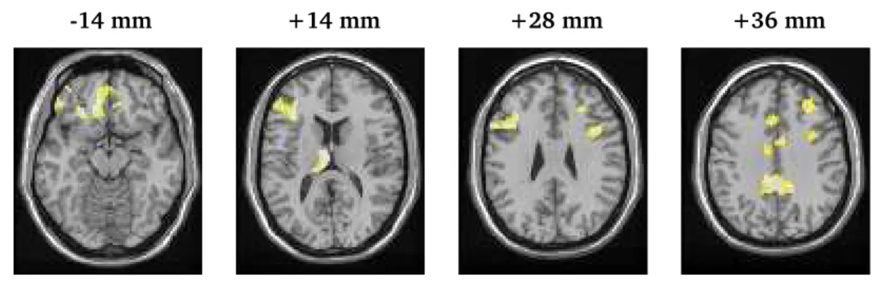Figure 1: Maps of voxel-specific treatment-emergent activations for the cocaine-dependent subjects, adjusted for the corresponding baseline-to-follow-up changes in the control subjects