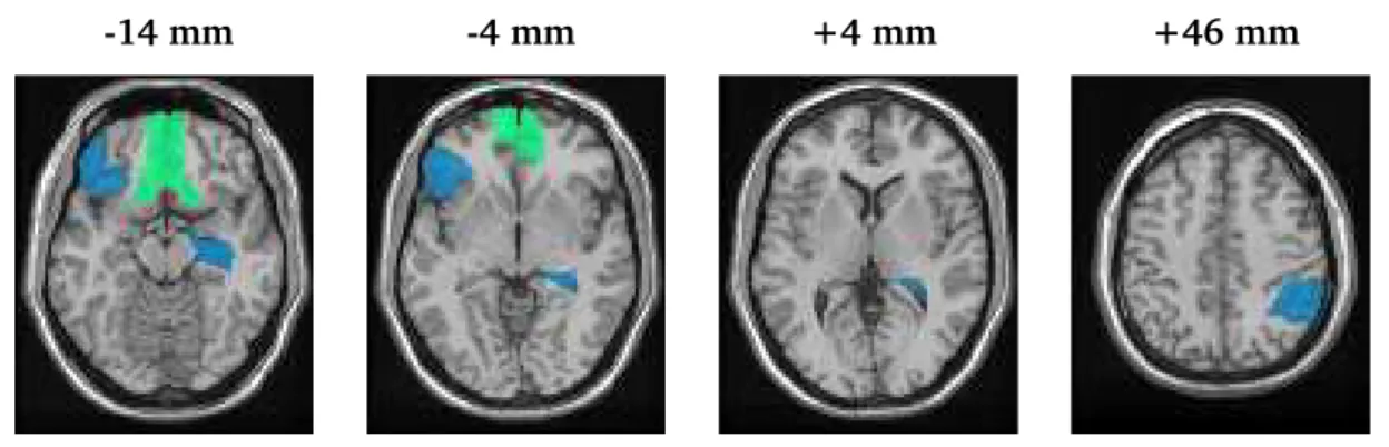 Figure 2: Map of regional treatment-emergent activations (green) and deactivations (blue) for the cocaine-dependent subjects, adjusted for the corresponding baseline-to-follow-up changes in the control subjects