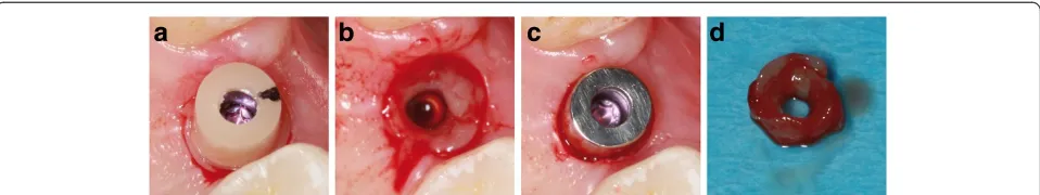 Fig. 2 Tissue sampling.biopsy and the zirconia abutment. a Clinical situation after applying the stamping press around the zirconia abutment