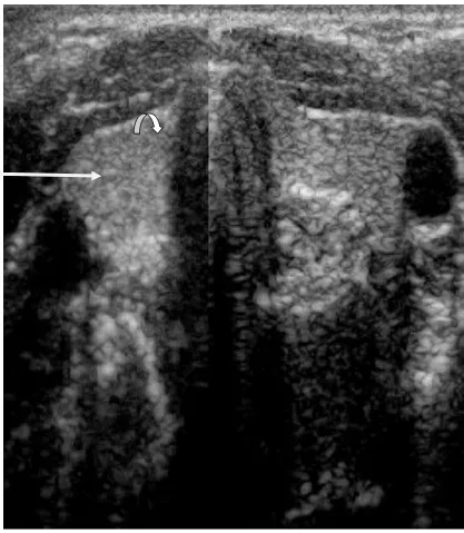 Fig 1: Transverse Ultrasound Scan of  the Thyroid Gland at the Level of the Tracheal Cartilage(C6 level) Showing its two lobes  (arrows), the isthmus(arrow head) and the trachea centrally(curved arrow)