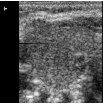 Fig 2: Longitudinal ultrasound scan of the thyroid, showing measurement of the longitudinal (LS)  and anteroposterior  diameters of the thyroid lobe