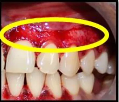 FIG 5:  Depigmentation using Diode laser on the right side lower quadrant  
