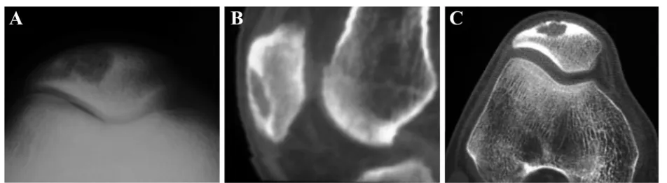 Figure 4 Patellar hemangioma. (A) Radiographs show a lytic lesion with sharp margins, thinning cortex, and sclerotic rim