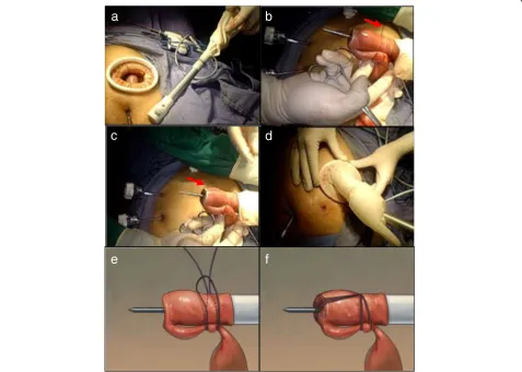 Figure 3 Placement of the anvil head.(b) (a) The tube of the anvil head was inserted transorally (picture downloaded from the website of Covidien)