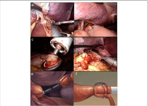 Figure 5 Intracorporeal anastomotic technique using a circular stapler. (a) Connection of the shaft and anvil