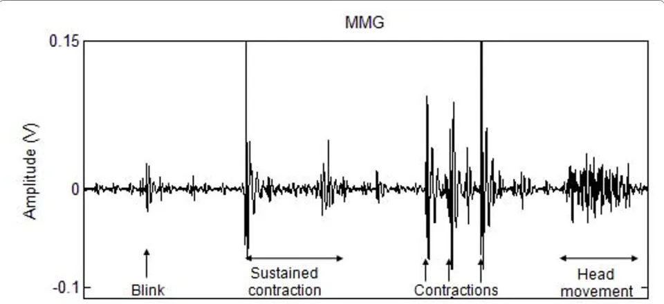 Figure 3 Typical MMG signal recorded from the frontalis muscle during quick and sustained eye-brow raises, eye blinks and head move-ment.