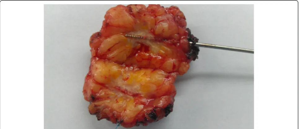 Figure 4 Resection procedure.