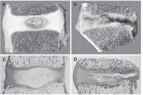 Figure 1 Degenerative changes of the intervertebral disc. Comparison of young and healthy (Nerlich A, Boos N