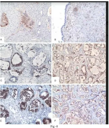 Fig -8  Hcg +ve in giant syncytotrophoblast(A) 