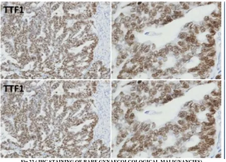 Fig 22 ( IHC STAINING OF RARE GYNAECOLCOLOGICAL MALIGNANCIES) ABBREVIATIONS – UEC- UNDIFFERENTIATED ENDOMETRIAL CANCER 