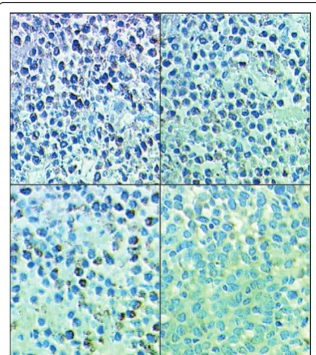 Figure 7 Effects of UTI and TAX on IL-8 protein expression inhuman breast cancer xenografts in immunohistochemistry: 1.Control group SP × 400 2
