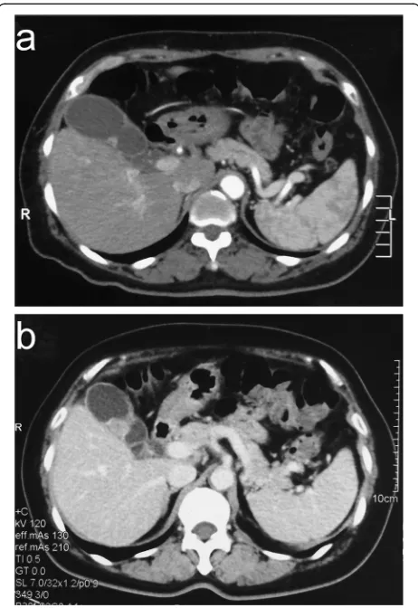 Figure 1 A fast-growing tumor located on the body of thegallbladder. (a) Computed tomography showed a suspected mass,measuring 0.6 cm, on the gallbladder plica 3.5 months prior