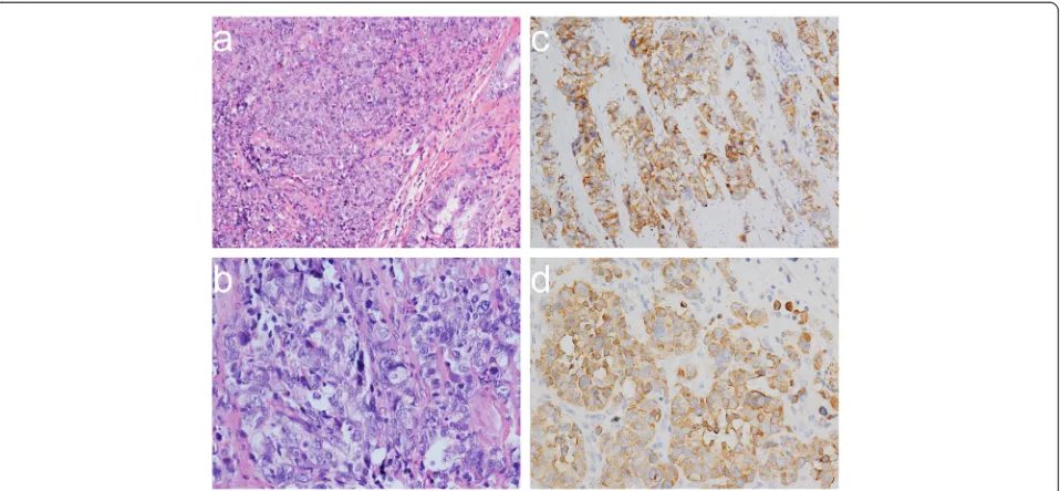 Figure 2 Pathologically demonstrated mixed large-cell neuroendocrine carcinoma and adenocarcinoma of the gallbladder