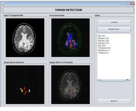 Figure-5. Tumor detection. 