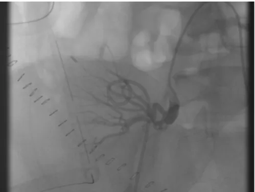Figure 1. Angiogram showing no flow into the renal artery from the external iliac artery