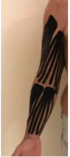 Figure 1. Taping cut fan or octopus (10% tension) in limb 