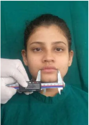 Figure 2- Measurement of Interpupillary Width 