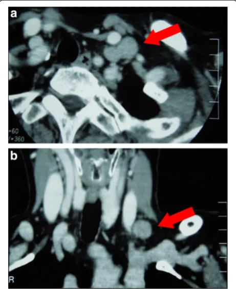 Figure 1 Preoperative CT findings. The CT showed a single leftsupraclavicular lymph node (arrow) (a) axial section, (b) coronalsection.