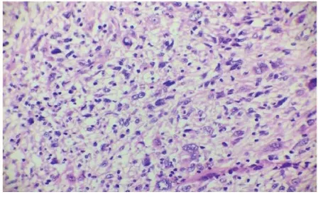 Fig. 3. Gross image showing extensive necrosis and infiltration into deep muscular Plain  