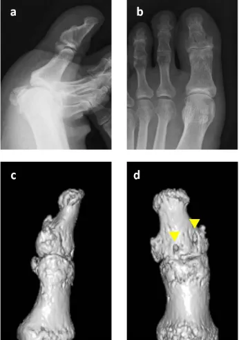 Figure 3. Surgical technique applied to the great toe. Intraoperative photographs after exposure of the fracture site (a), insertion of the two suture anchors (b) and fixation of the bone fragment with the bridging technique (c)