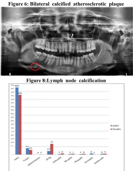 Figure 6: Bilateral  calcified  atherosclerotic  plaque 