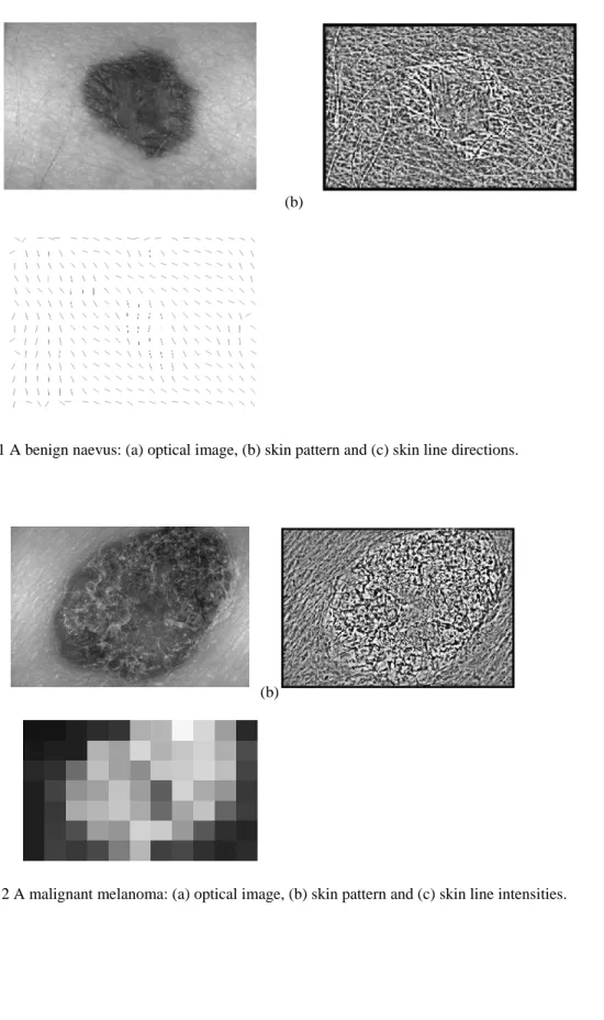 Fig. 2 A malignant melanoma: (a) optical image, (b) skin pattern and (c) skin line intensities