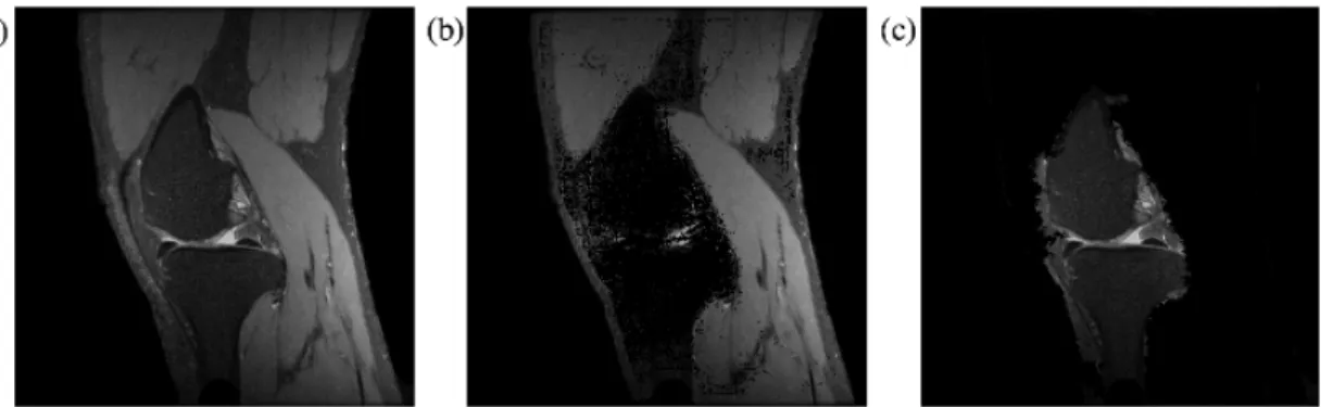 Figure 9: The result of SVM classification with SSLBP feature extraction   (a) Pre-processed Image, (b) The Result of classification, (c) and extracted bone from the 
