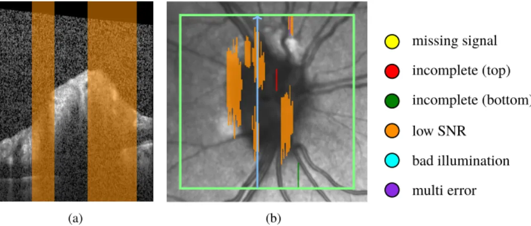 Fig. 8. Quality assessment of a volume scan: (a) B-scan with low SNR region in orange, (b) corresponding SLO image with quality assessment map, color coded according to the criteria shown at the right hand side of the map; green rectangle delimits the scan