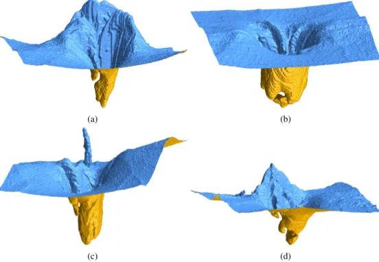 Fig. 12. 3D view of the ILM segmentation results showing particularly interesting topologies at the ONH.