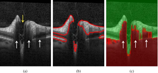 Fig. 2. a) B-scan presenting several challenges for ILM segmentation using the original CV model: the yellow arrow shows the ONH region with no retinal layer information except several tissue remaining from nerve fibers and the ILM; the white arrows show s