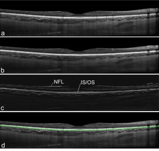 Figure 2. Example of the inner choroidal boundary segmentation steps, including the original B-scan (a), the pre- pre-processed image (b), the vertical gradient information shown at the same scale as the original (c) and the original  image with the segmen